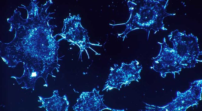 Le cellule cancerose si nutrono anche dei neuroni