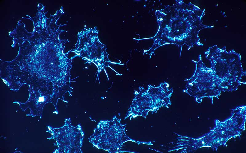 Le cellule cancerose si nutrono anche dei neuroni